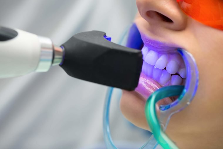teeth whitening devices
